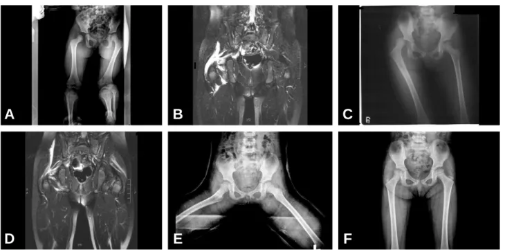Fig. 1. (A) Initial radiograph in 3-year-old girl demonstrates incomplete reduction of right hip joint