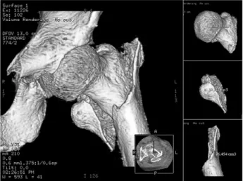 Fig. 1. Demonstration of volumetric analysis of Jensen type 4 intertrochanteric fracture of the femur by 3D computed tomography scanning.