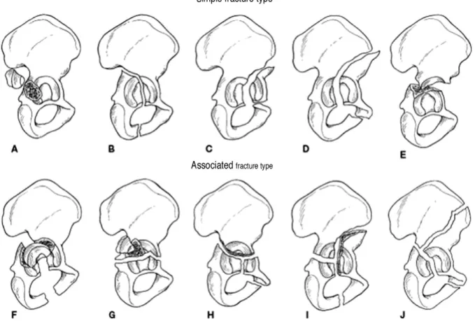 Fig. 1. Letournel &amp; Judet classification of acetabular fractures.