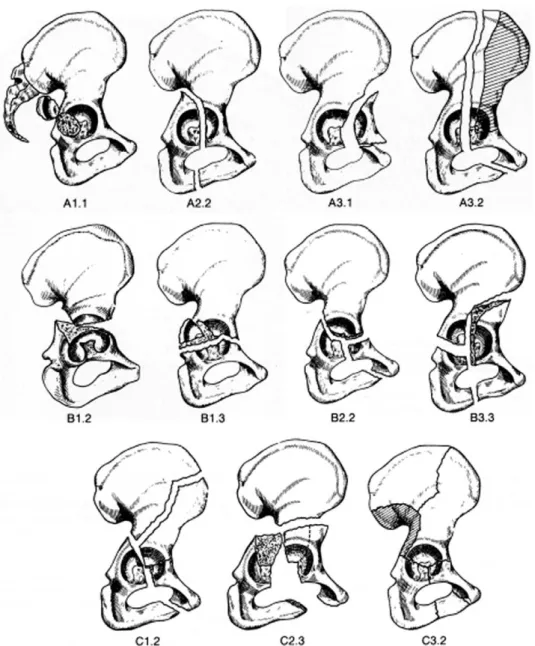 Fig. 2. AO group classification of acetabular fractures.