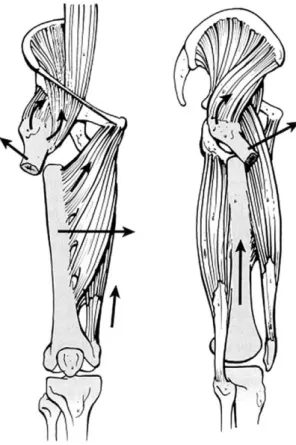 Fig. 1. Koch’s diagram showing the compression stress on the medial side and the tension stress on the lateral side of the proximal femur.