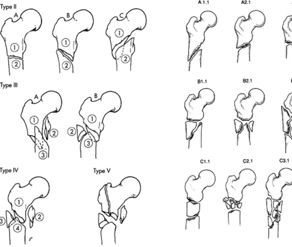 Fig. 3. Seinsheimer classification Fig. 4. AO-ASIF classification