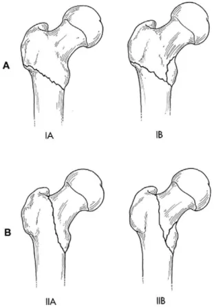 Table 1. Treatment recommendations based on Russell-Taylor classification of subtrochanteric fractures.