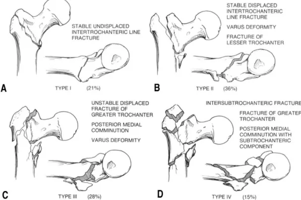 Fig. 3. Kyle &amp; Gustilo classification of intertrochanteric fracture