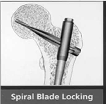 Fig. 16. Basicervicotrochanteric fracture  Fig. 17. Spiral Blade Nail
