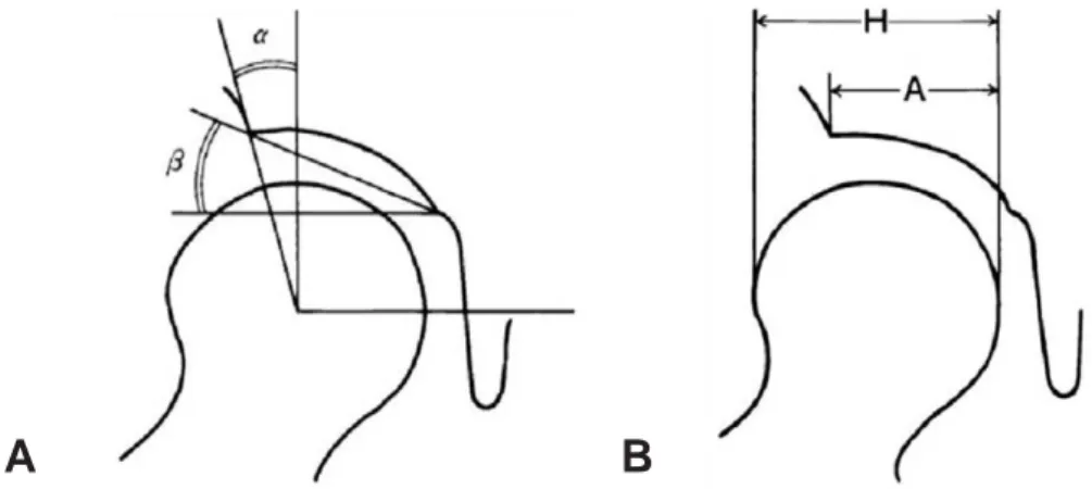 Fig. 1. (A) The CE angle (α) and the acetabular roof obliquity (ARO), (B) The acetabular head index is calculated by A/H×100