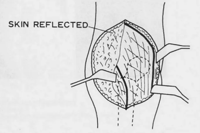 Fig. 4. Approach of rotational acetabular osteotomy. The approach combines the anterior iliofemoral and posterior approaches through a single skin incision.