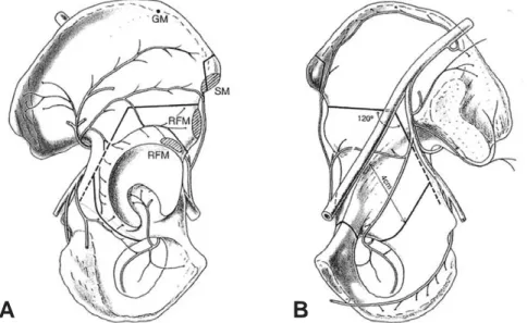 Fig. 7. Bernese periacetabular osteotomy. (A) External surface, (B) Internal surface