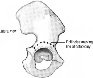 Fig. 9. The line of osteotomy which is marked by multiple drill holes.