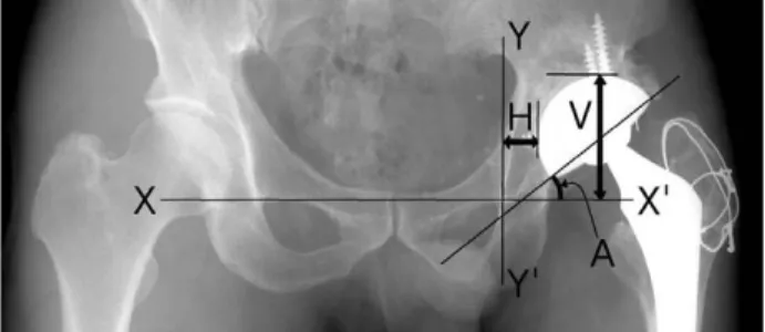 Fig. 2. The radiological evaluation of cup position change, such as vertical migration (V), horizontal migration (H) and cup angle change (A) from the horizontal line  (X-X’) and the vertical line (Y-Y’).