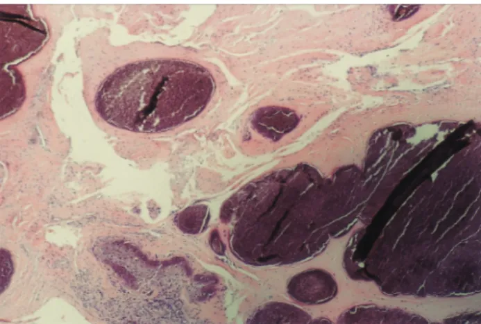 Fig. 6. The dystrophic calcified mass surrounded by monocytes, giant cells, histiocytes and chronic inflammatory cells
