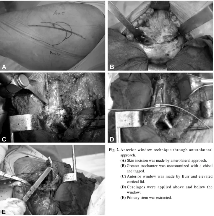Fig. 2. Anterior window technique through anterolateral approach.