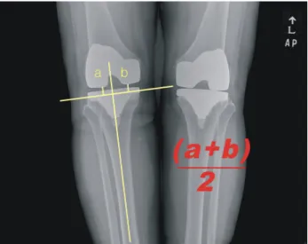 Fig. 1. The method of pre-operative measurement of the joint Fig. 2. The method of post-operative measurement of the joint 화가 있는지 여부와 후방십자인대 보존 여부에 따라 관절선 위치가 차이가 있는지를 분석하여 보고자 하였다.대상 및 방법1996년 9월부터 2005년 6월까지에 본원에서 일인 시술자에  의해 슬관절  전치환술을 시술받은 환자 중 일측은 후방십