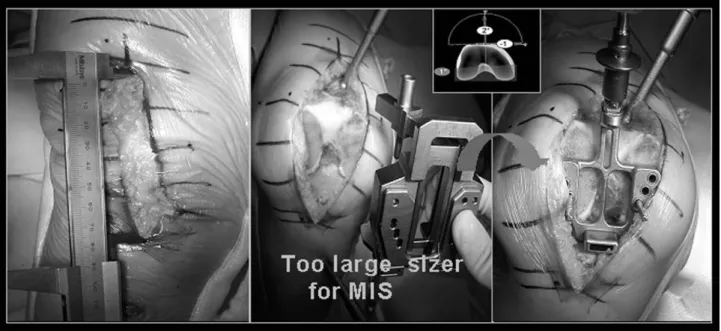 Fig. 1. For Minimal invasive TKA, Naivgation- assisted TKA was more easy and comfortable than conventional method.
