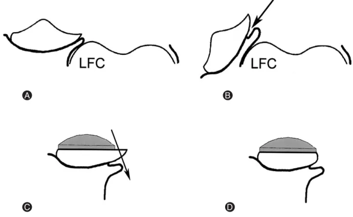 Fig. 2. Lateral retinacular peel involves releasing the extensor retinaculum from the lateral border of the patella using electrocautery and peeling it (B) as the patella is being everted (A) during exposure