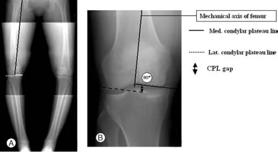 Fig. 1. CPL gap is the difference of height between the med. and lat. condylar plateau lines which are perpendicular to the mechani- mechani-cal axis of the femur.