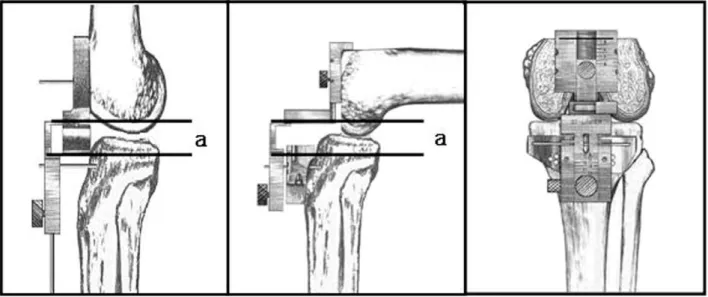 Fig. 5. Flexion-extension gap balancing and determination of the size of femoral component using gauge (Linker gauge)