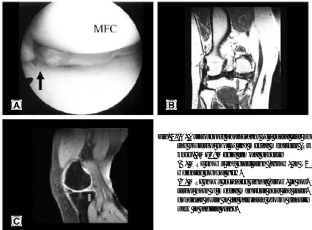 Fig. 1. (A) Arthroscopic photographs of a radial tear of the posterior root of the medial meniscus (Rt knee)