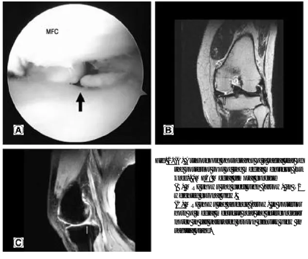 Fig. 2. (A) Arthroscopic photographs of a radial tear of the posterior root of the medial meniscus (Lt knee)