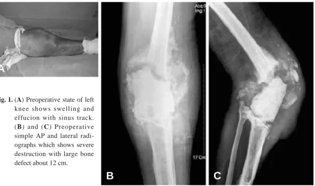 Fig. 1. (A) Preoperative state of left knee shows swelling and effucion with sinus track.