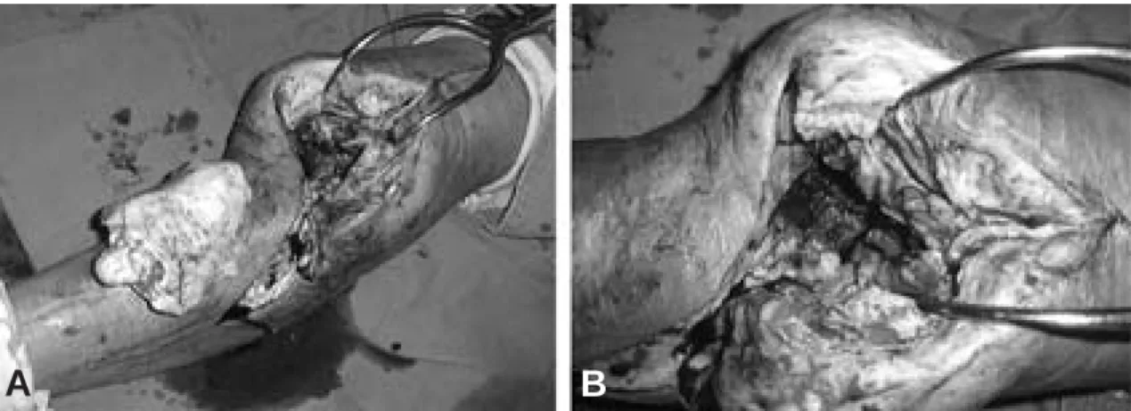 Fig. 2. Intraoperative pictures show (A) Incision line including previous incision scar with new lateral incision for vascularized fibular harvest and extracted large cement spacer (B) thick scar tissue and inflamed surrounding tissue with large bone defec