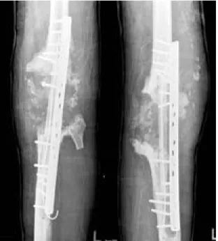 Fig. 5. At postoperative 1 year and 5 months, there are fractures of plate and grafted fibular (A), so fixative materials were changed with endernails, but 10 months later, inserted endernails were fractured again (B).