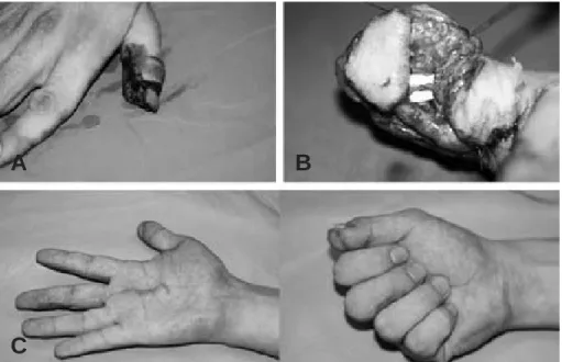 Fig. 2. (A) Right thumb, pulp defect of a 27-year-old male. (B) Lateral middle phalangeal finger flap was elevated from the ulnar side of middle finger and transported through the palmar tunnel