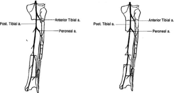 Fig. 1. Antegrade-flow pedicle based on the peroneal vessels for proximal defect.