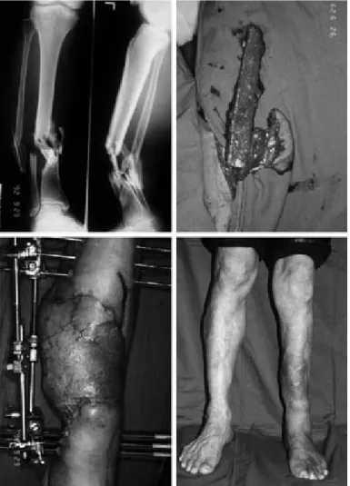 Fig. 4. A 49-year old male patient sustained from open tibiofibular fracture on the left lower leg