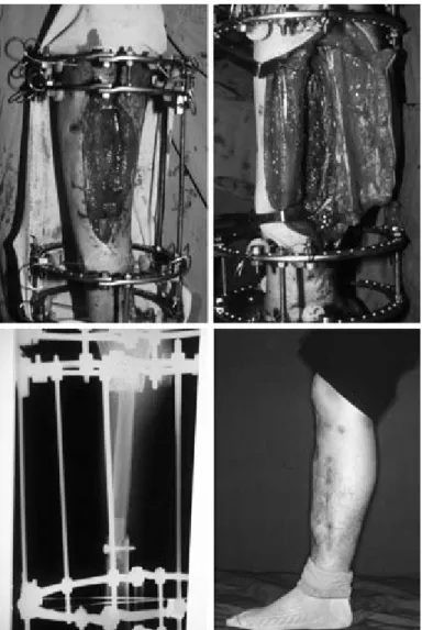 Fig. 6. A 26-year old male patient sustained from traffic accident with type IIIb open tibia fracture