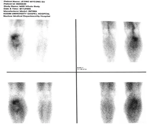 Fig. 2. Bone scan shows a high uptake in right proximal tibia