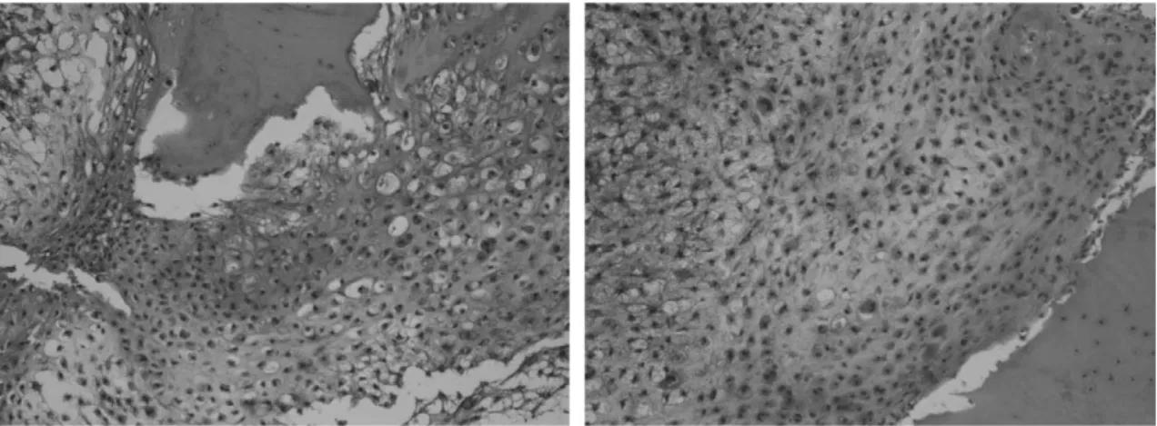 Fig. 4. Chondrosarcoma, grade II: Tumors show increased and cells have nuclear atypia