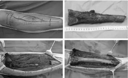 Fig. 6. Plain radiographs after operation. Allograft was used for reconstruction.