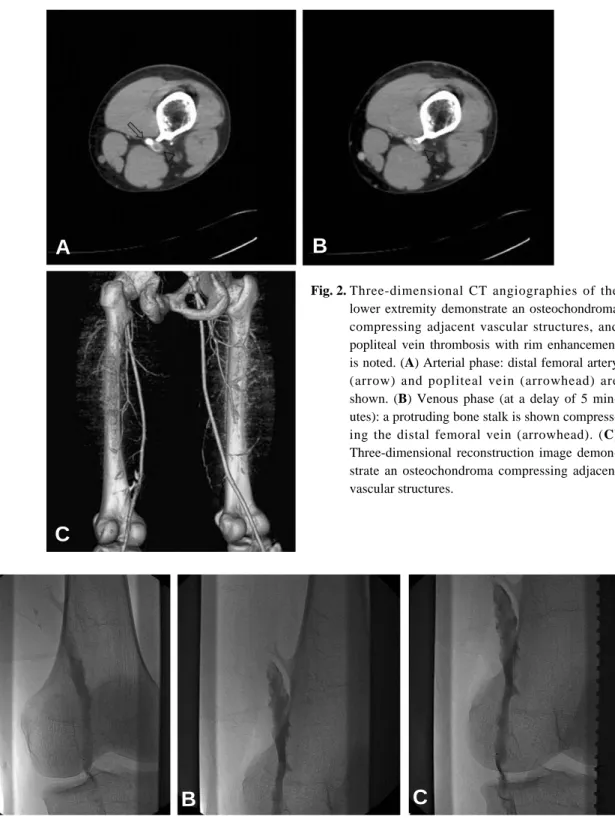 Fig. 2. Three-dimensional CT angiographies of the lower extremity demonstrate an osteochondroma compressing adjacent vascular structures, and popliteal vein thrombosis with rim enhancement is noted