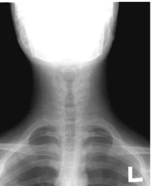 Fig. 2. Preoperative cervical spine, lateral view. The complete osteoclastic state is shown, viewing the vertebral body of C3 as an upper end plate  sil-houette