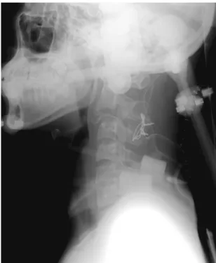 Fig. 3. Preoperative cervical spine, MRI sagittal image.