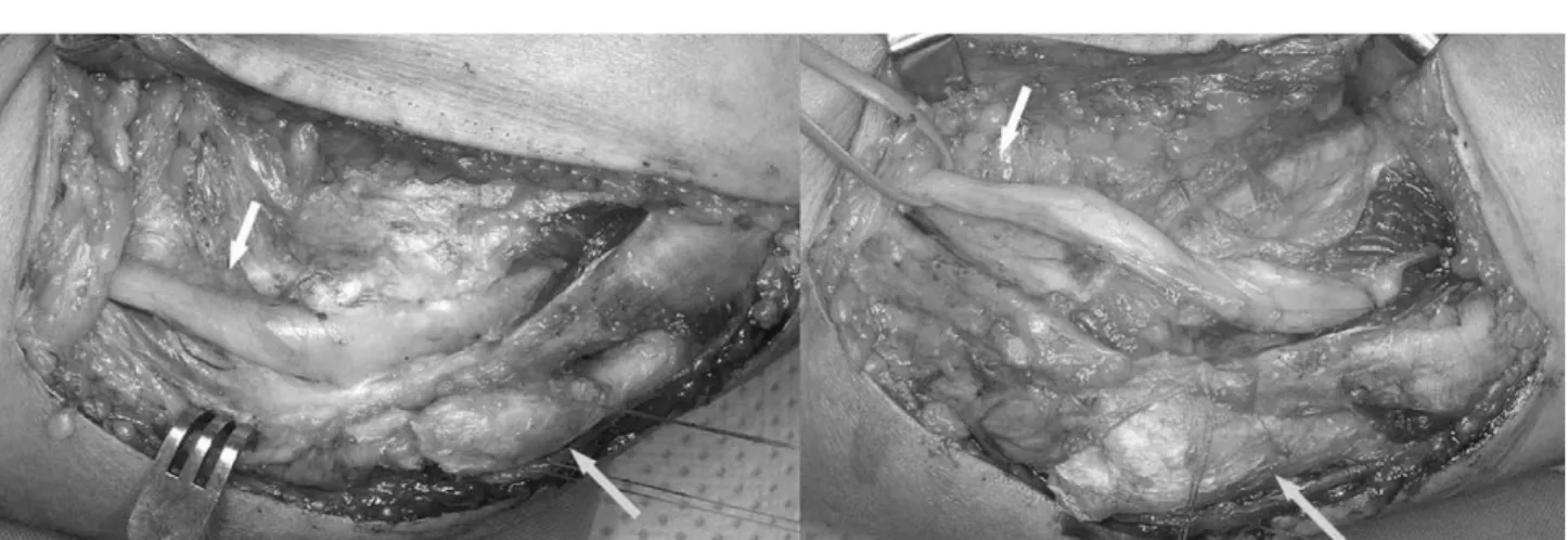 Fig. 5. Postoperative radiograph shows complete removal of the heterotopic ossification.
