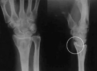 Fig. 1. Bony protuberance on the volar side of the radius (round circle).