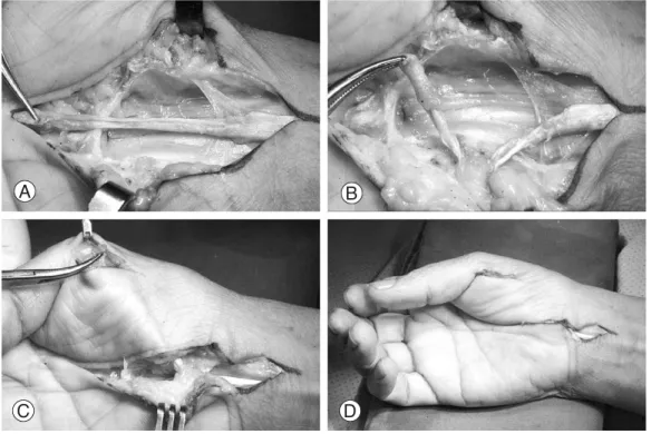 Fig. 1. Technique for modified Camitz opponensplasty. (A) The operation was performed by incising 6cm on the palm following the ulnar side of palmaris longus, and the palmaris longus was dissected free, in continuity with a longitudinal strip of the palmar