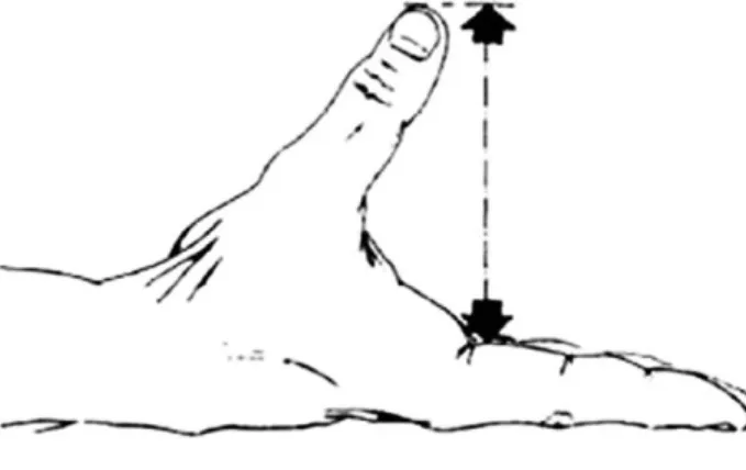 Fig. 2. Van Wetter’s apogee allowing to measure palmar abduction in centimeters.