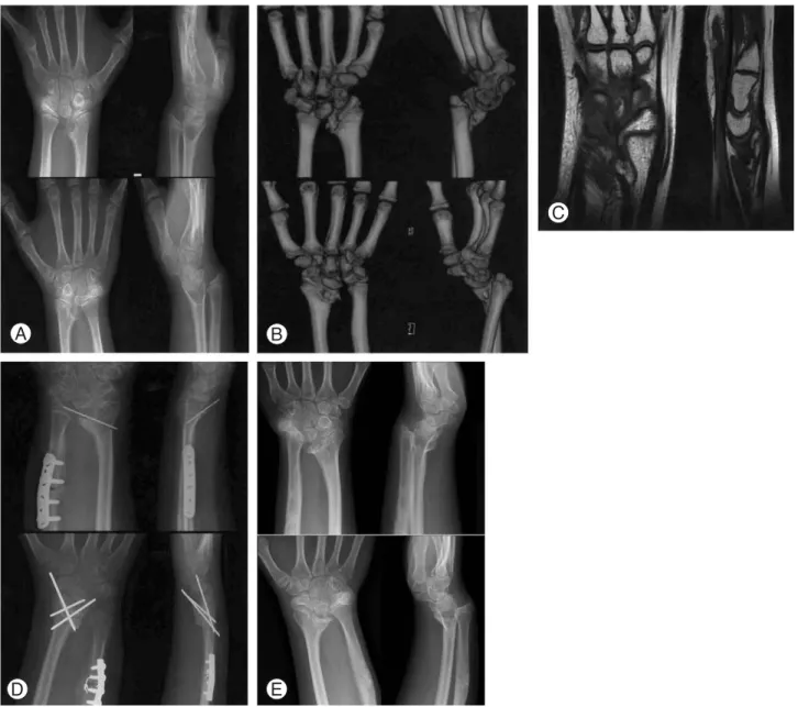 Fig. 2. Congenital bilateral Madelung’s deformity of 11 year old female patient. (A) Preoperative both wrist AP and lateral radiogra- radiogra-phy showing increased dorsal and radial bowing of the distal radius, medially an area of localized lucency at the