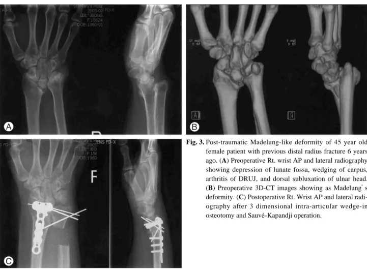 Fig. 3. Post-traumatic Madelung-like deformity of 45 year old female patient with previous distal radius fracture 6 years ago