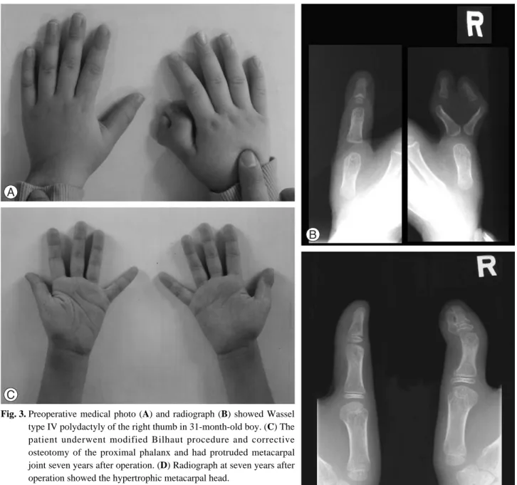 Fig. 3. Preoperative medical photo (A) and radiograph (B) showed Wassel type IV polydactyly of the right thumb in 31-month-old boy