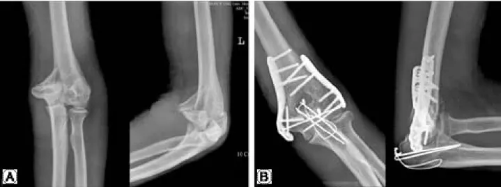 Fig. 1. (A) Preoperative elbow radiographs of humerus intercondylar fracture which was classified C3 type by AO/ASIF classifica- classifica-tion system