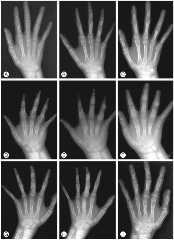Fig. 1. A-I. Lobboc � was well incorporated into the host bone before 6 month postoperatively