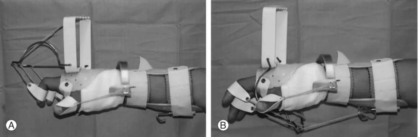 Fig. 1. Thermoplastic dynamic splint for active flexion (A) and extension (B) of the all fingers with keeping the wrist position in neutral.