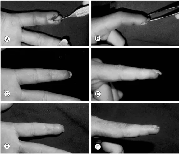 Fig. 1. Case 1. (A, B) A 27-year-old male with deep pulp defect and bone exposure of the left second fingertip after paint-gun injury.