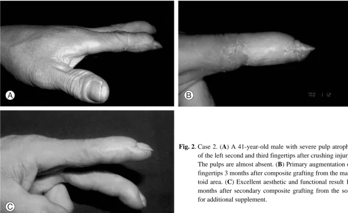 Fig. 2. Case 2. (A) A 41-year-old male with severe pulp atrophy of the left second and third fingertips after crushing injury.