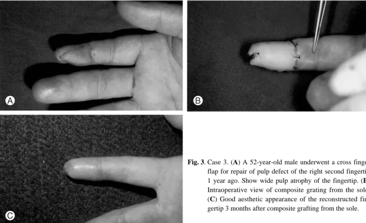 Fig. 3. Case 3. (A) A 52-year-old male underwent a cross finger flap for repair of pulp defect of the right second fingertip 1 year ago