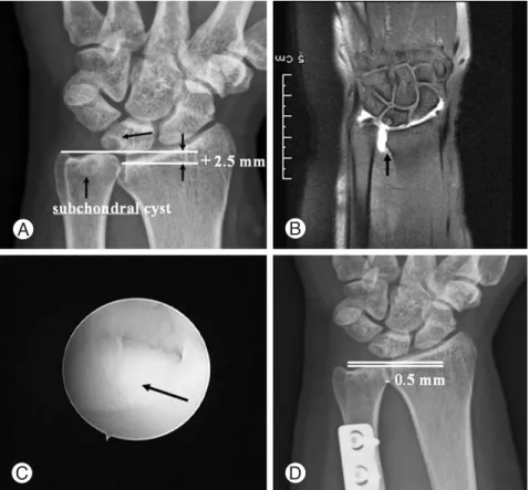 Fig. 1. (A) The initial x-ray shows +2.5 mm positive ulnar variance and subchondral cysts at lunate and ulnar head